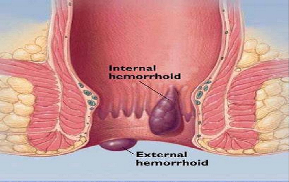 Hemorroides estres