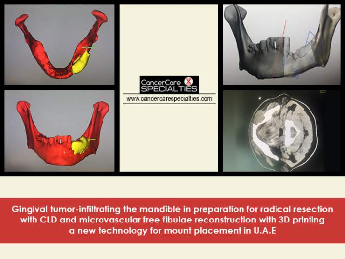 Gingival tumor-infiltrating the mandible in preparation for radical resection with CLD and microvascular free fibula reconstruction with 3D printing a new technology for mount placement in UAE